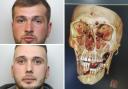 The victim was left with shattered jaw after the 